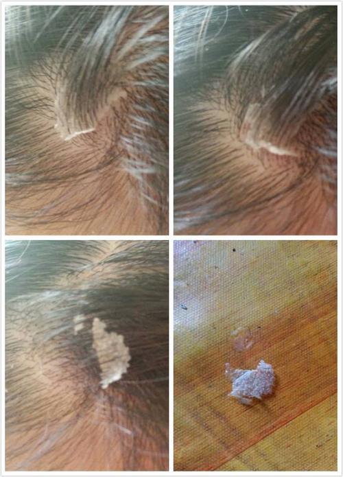 微信张老师中医去头屑