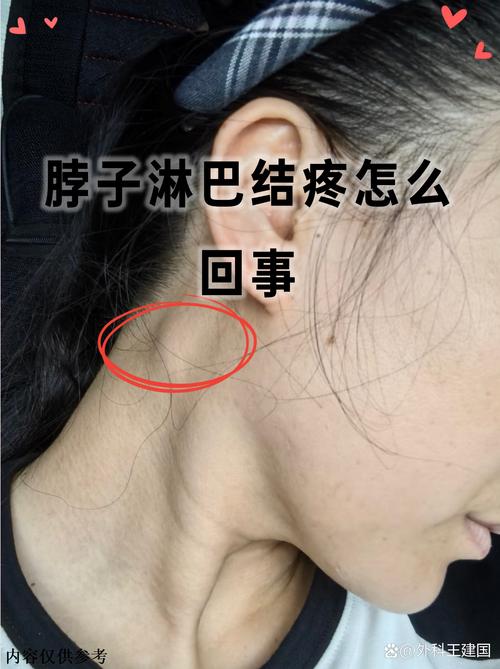 颈部淋巴结发炎的饮食