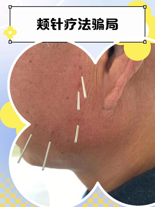 腘窝脓肿 针灸穴位