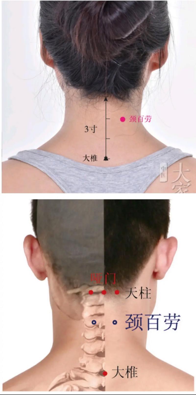 脖子扭伤针灸什么穴位