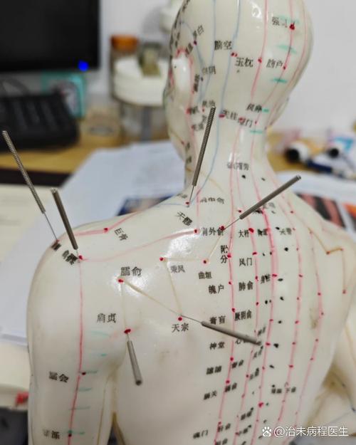 肩周炎可以针哪些穴位