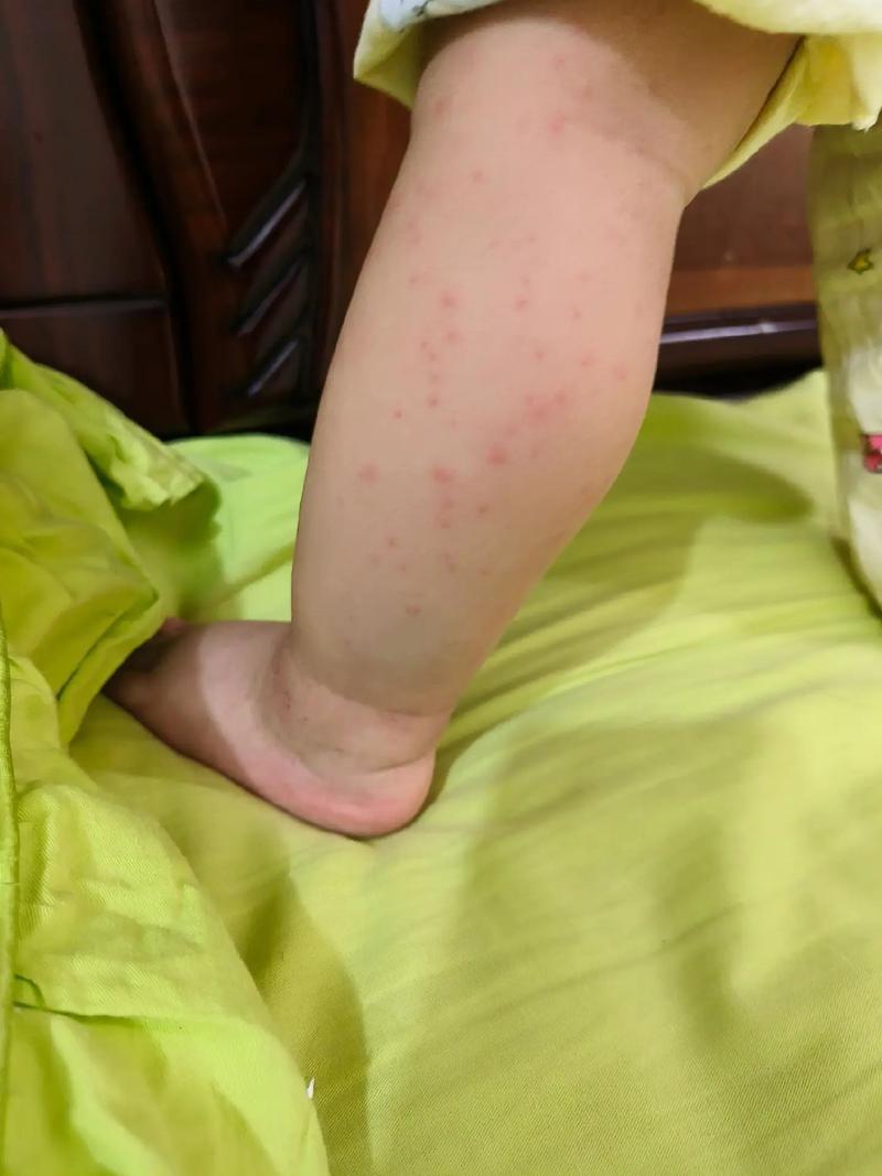 婴儿急疹出疹后的饮食