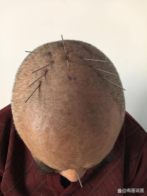 面部痉挛抽搐针灸穴位