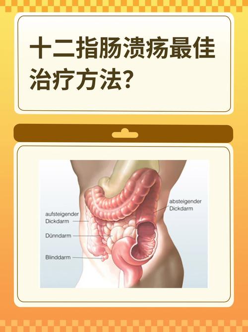 十二指肠溃疡怎么饮食
