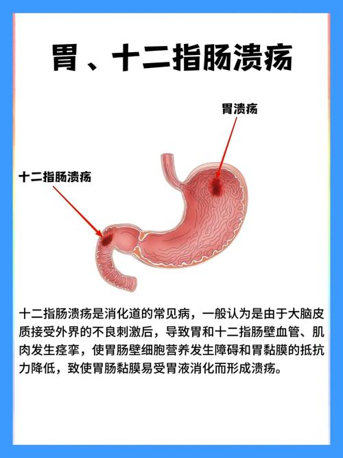 十二指肠溃疡怎么饮食