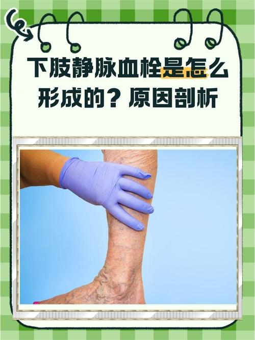 中医治疗下肢静脉血栓