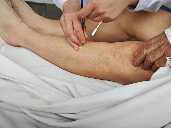 角化症穴位注射 肝炎