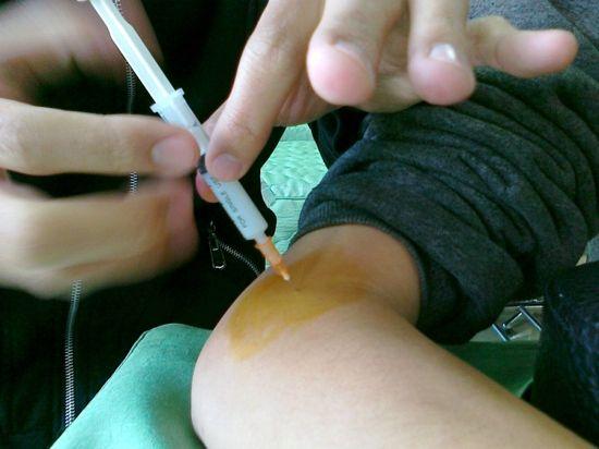 角化症穴位注射 肝炎