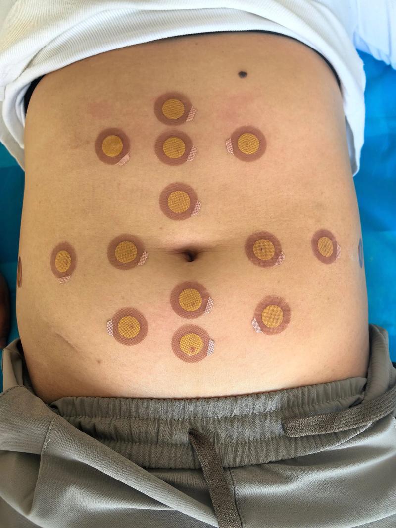 北京中医院 埋线减肥