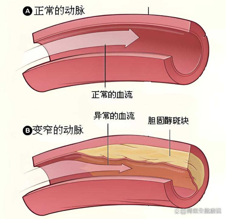 中医治疗冠状动脉狭窄