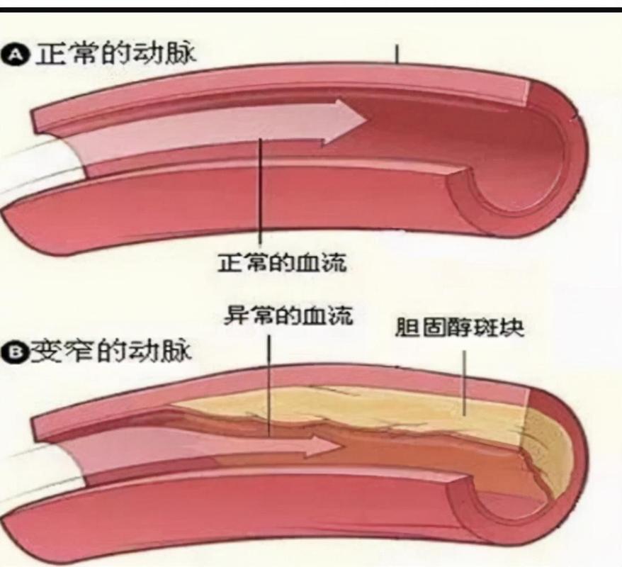 中医治疗冠状动脉狭窄