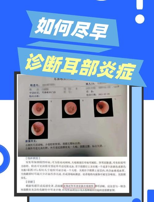 儿童大疱性鼓膜炎饮食