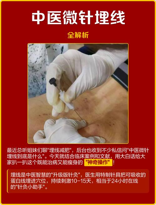 中医针灸埋线的副作用