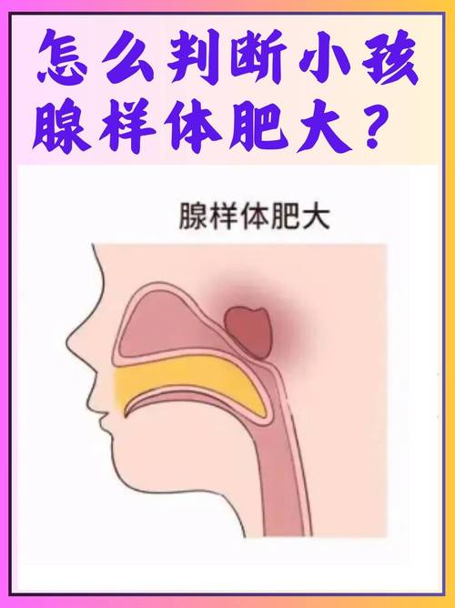 中医腺样体肥大辩证论