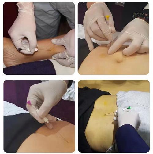 长沙中医附一埋线减肥