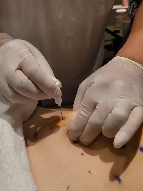 长沙中医附一埋线减肥