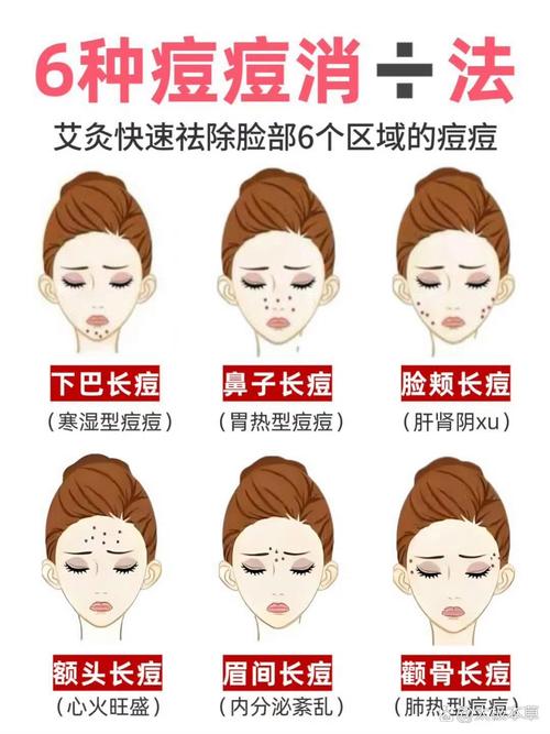 艾灸痘痘面部哪个穴位