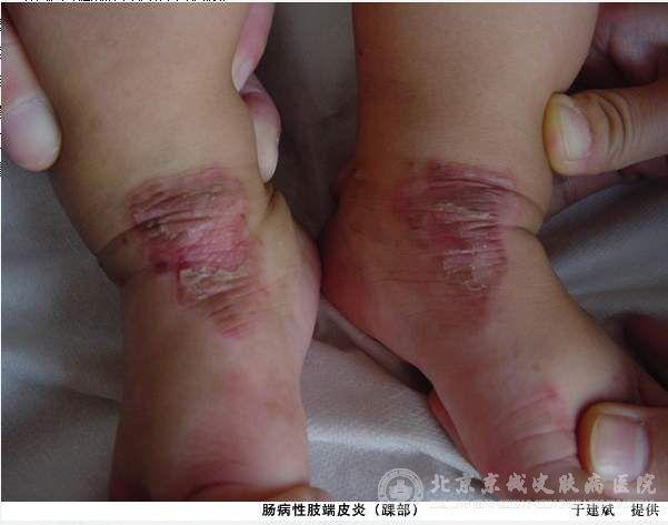 肠病性肢端性皮炎饮食