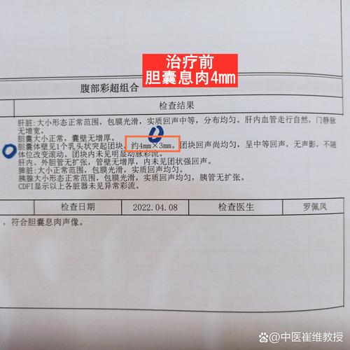 胆囊息肉的中医特效方