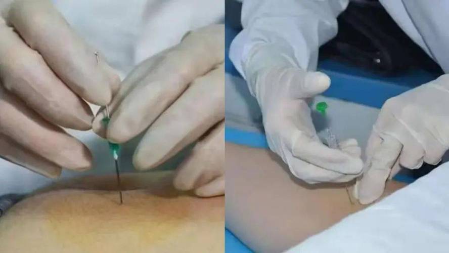 中医埋线减肥操作视频