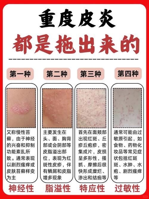 皮炎看中医还是西医好