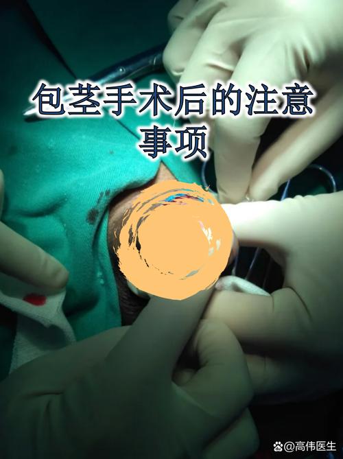 小儿包茎手术后的饮食