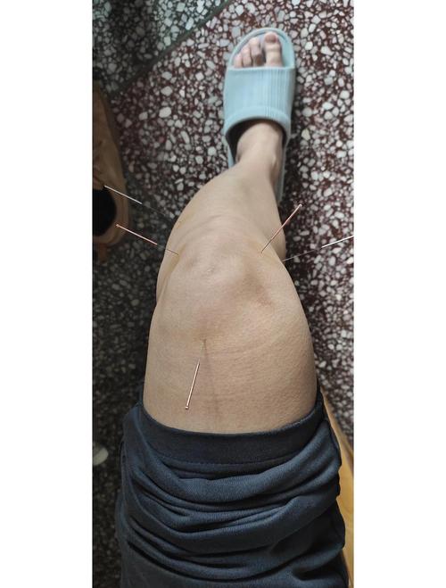 膝盖风湿痛拔火罐穴位