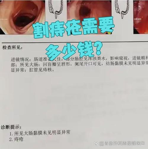 南京中医院痔疮多少钱