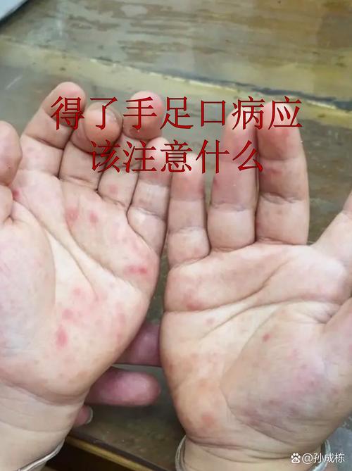 手足口病初期饮食禁忌