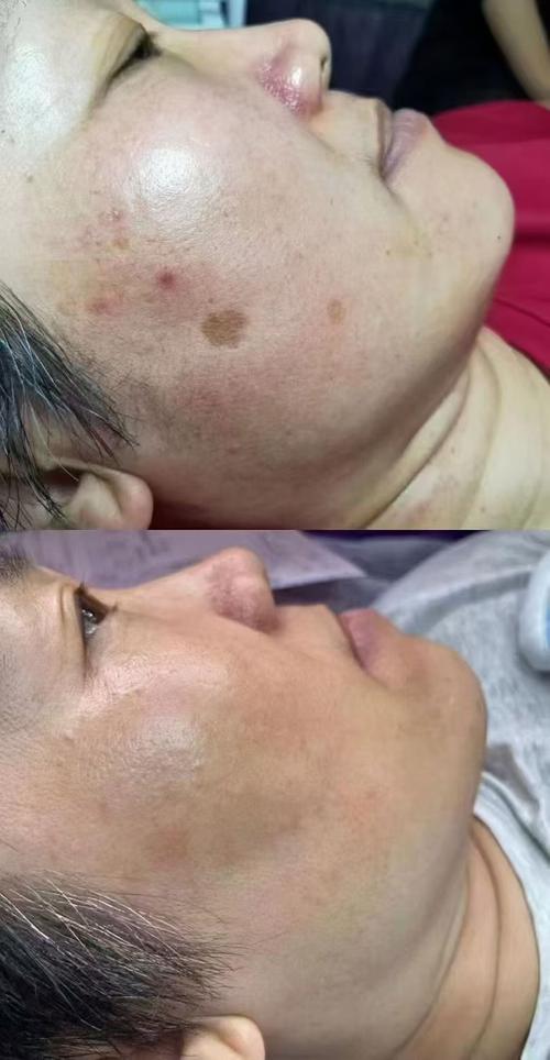 中医治疗脂溢性角化症