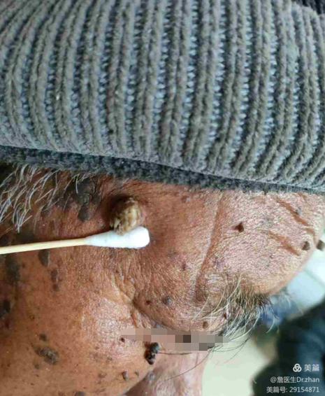 中医治疗脂溢性角化症