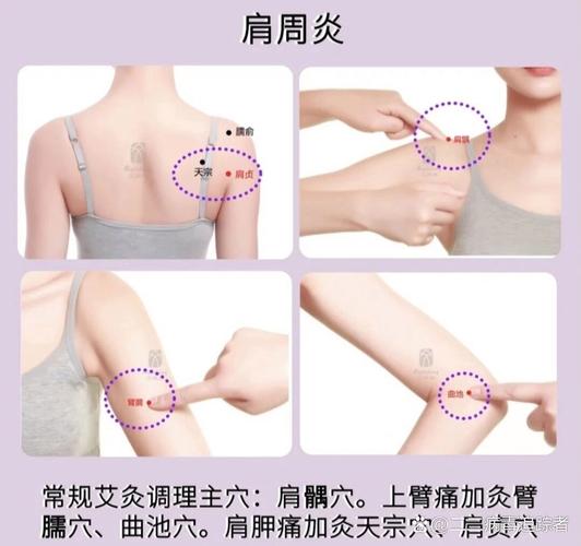 肩周炎掌灸什么穴位