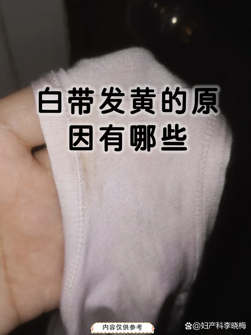 白带发黄和饮食有关吗