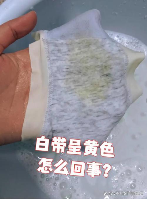 白带发黄和饮食有关吗