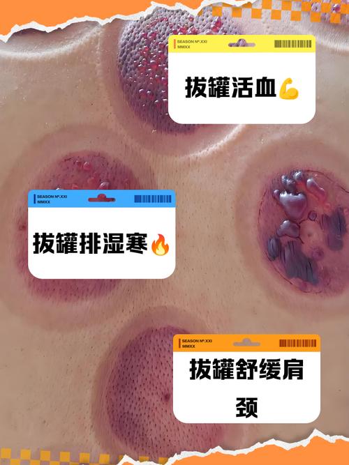 什么穴位不能拔罐子