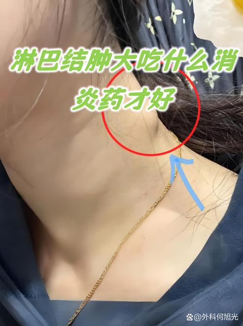 颈部右侧淋巴肿大饮食