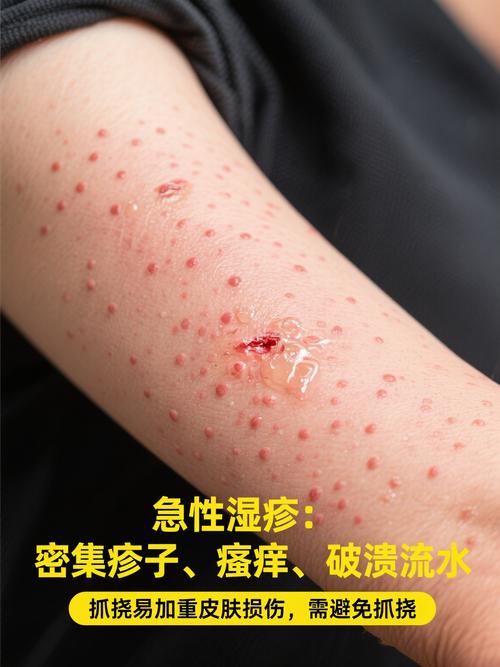 曲靖中医院湿疹霜图片