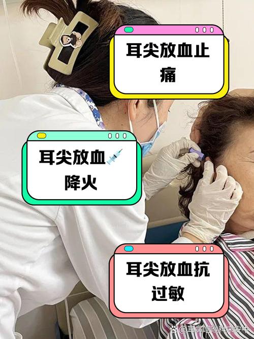 穴位放血疗法治耳鸣