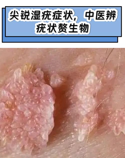 中医治疗尖锐疣有效吗