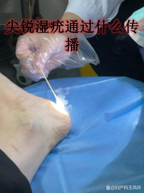 贵阳看尖锐疣来选中医