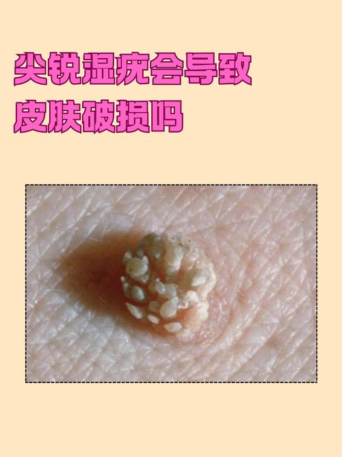 贵阳看尖锐疣来选中医