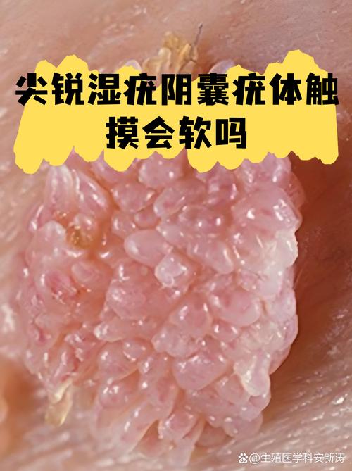 贵阳看尖锐疣来选中医