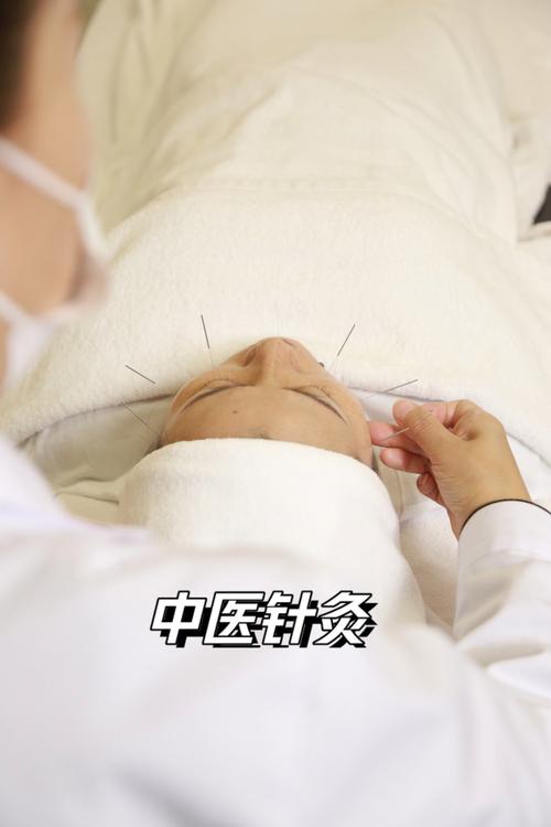 痤疮针灸穴位有哪些