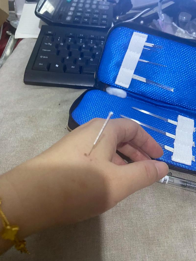 痤疮针灸穴位有哪些