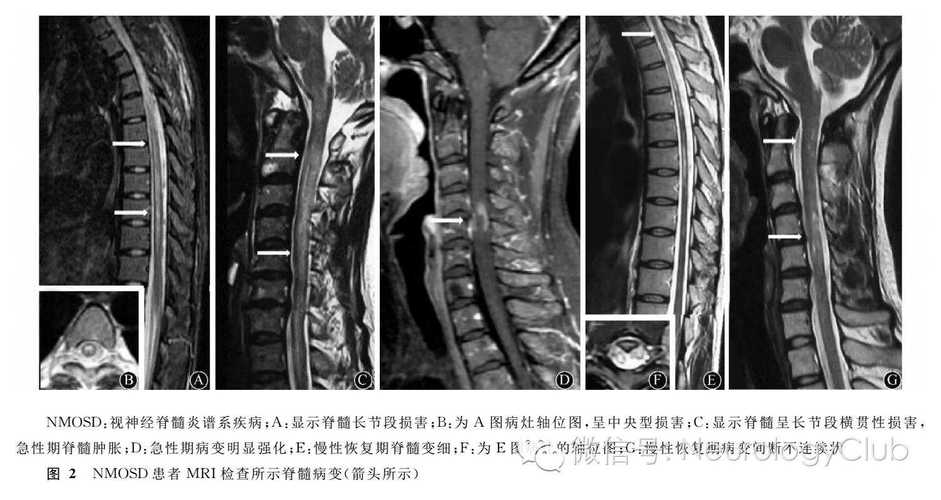 视神经脊髓炎中医诊治