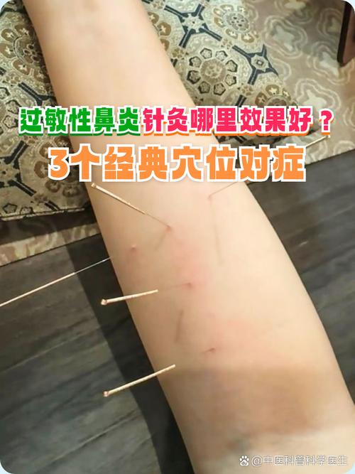身体过敏掐哪个穴位