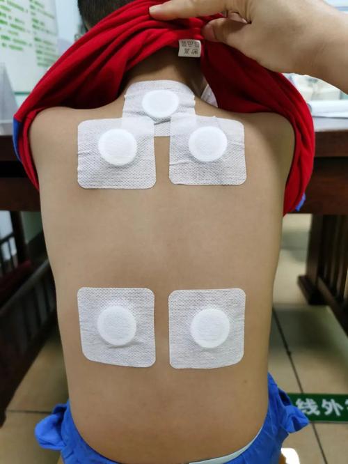 东方医院的穴位敷贴