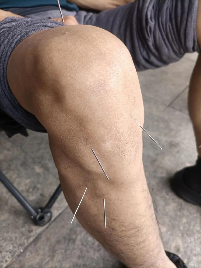 滑膜炎艾灸穴位针灸