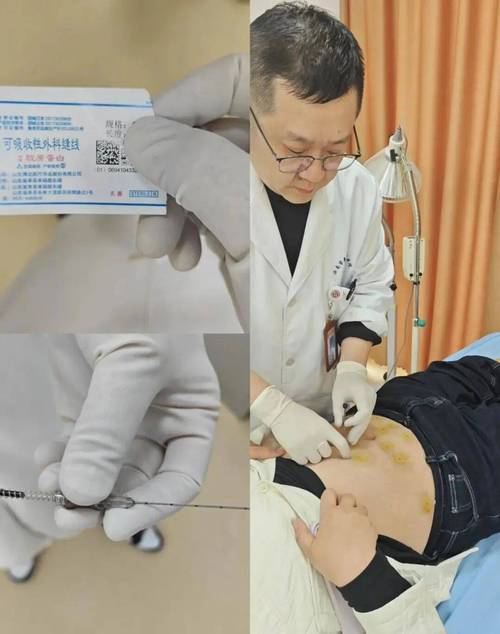 穴位蛋白埋置的作用