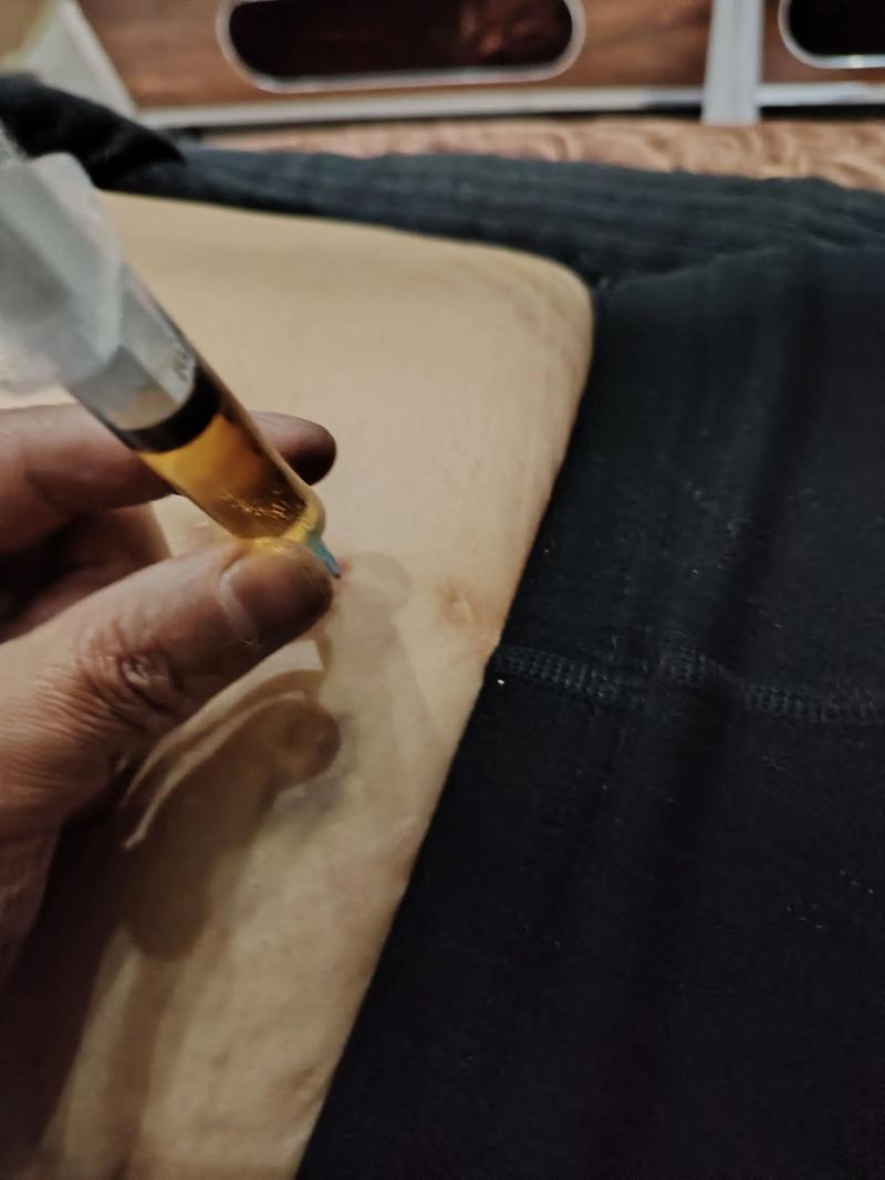 穴位注射的操作步骤